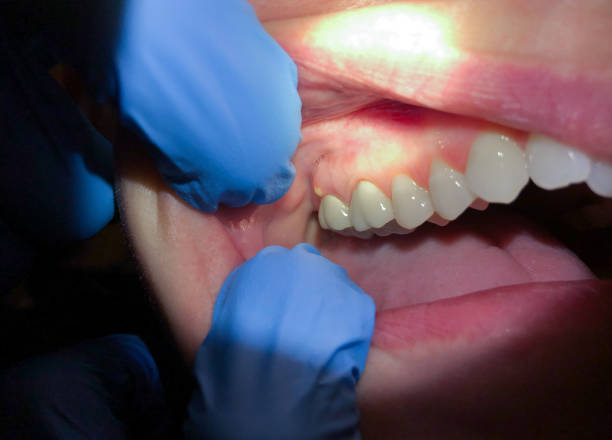Best Emergency Root Canal Treatment in North Lakeport, CA